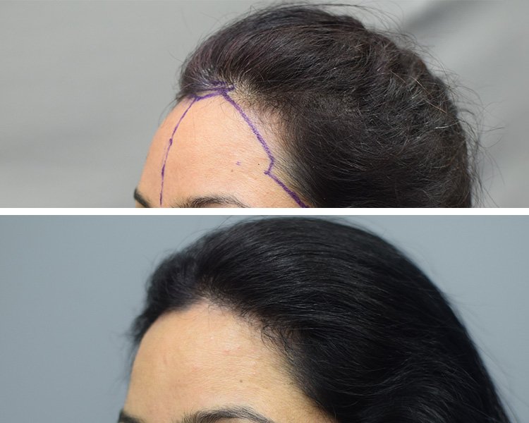 Female Hair Transplant