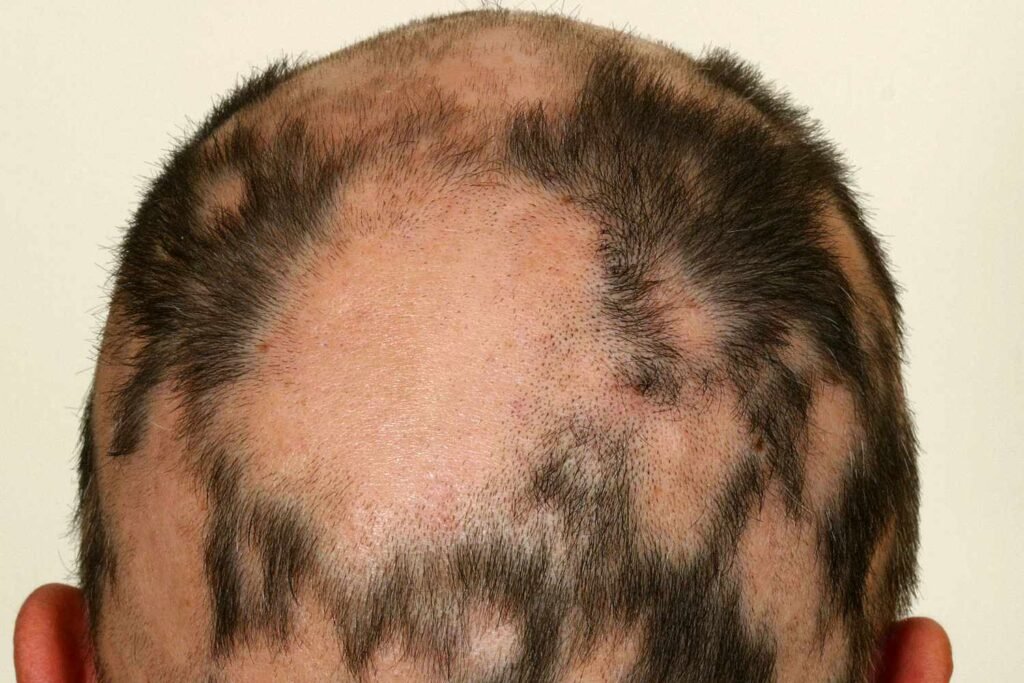 Alopecia