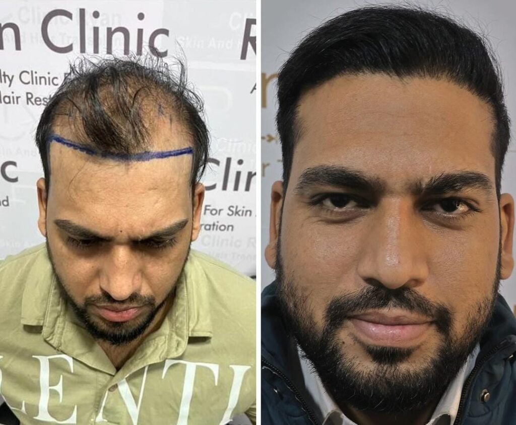 Hairline Reconstruction Results Before and After