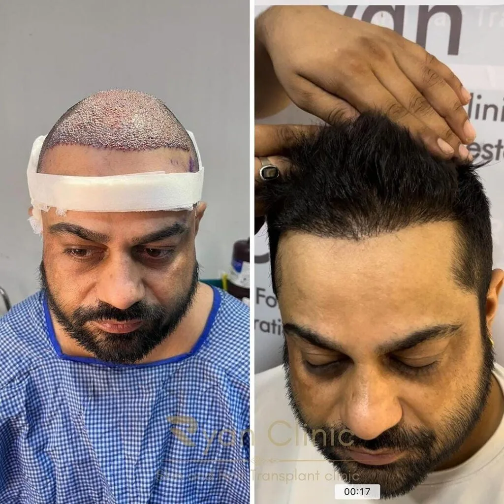 Hair Transplant Result Before and After