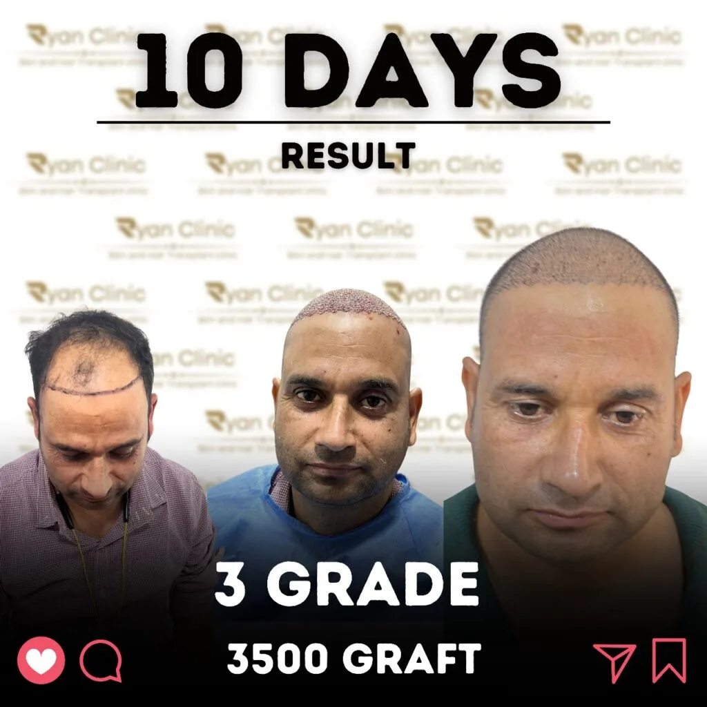 Hair Transplant Result After Ten Days