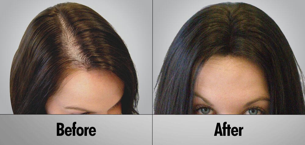 Female Hair Transplant