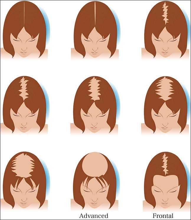 Female Hair Transplant