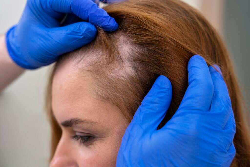 Female hair transplant