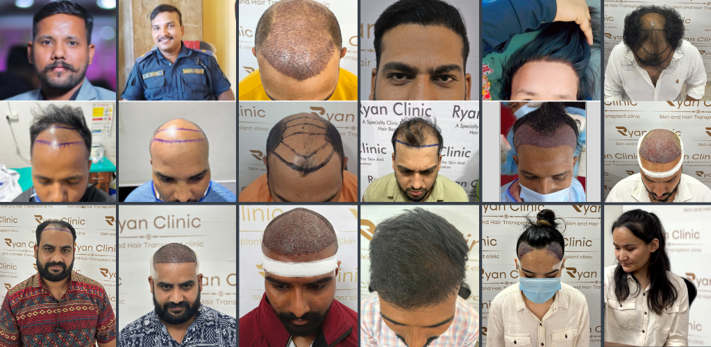 FUE Hair Transplant in India