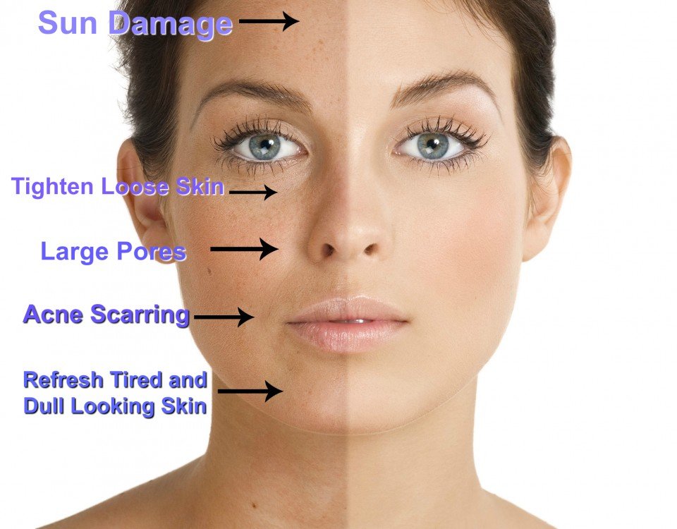 Chemical Skin Peels