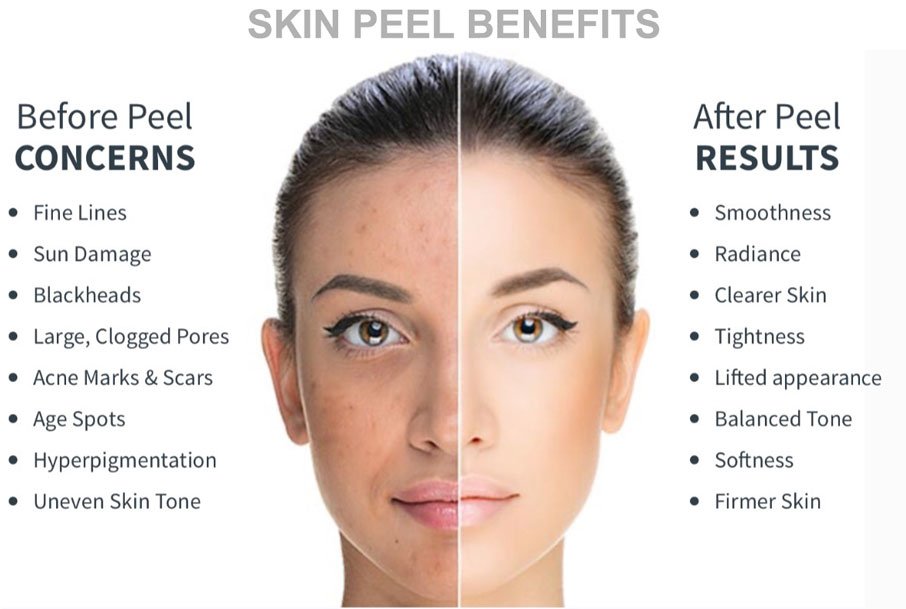 Chemical Skin Peels