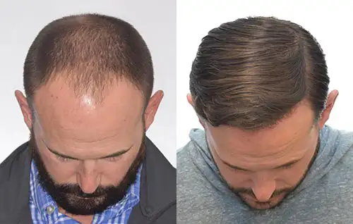 FUE Hair Transplants