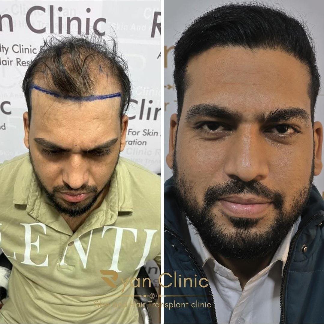 Hair Transplant Result After six Months