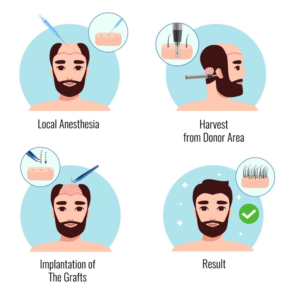 Best fue hair transplants in India